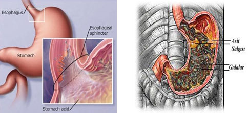 Gastrit
