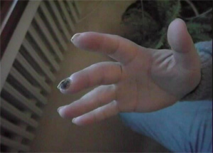 Raynaud Hastal